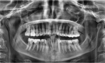 Study Reveals Your Teeth Might Predict Early Death
